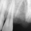 x-ray of left missing tooth