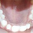 view of missing upper canine tooth