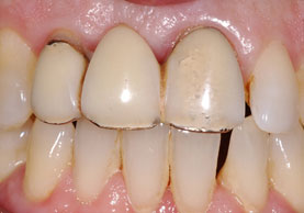 BEFORE IMPLANT 3 UNIT BRIDGE 