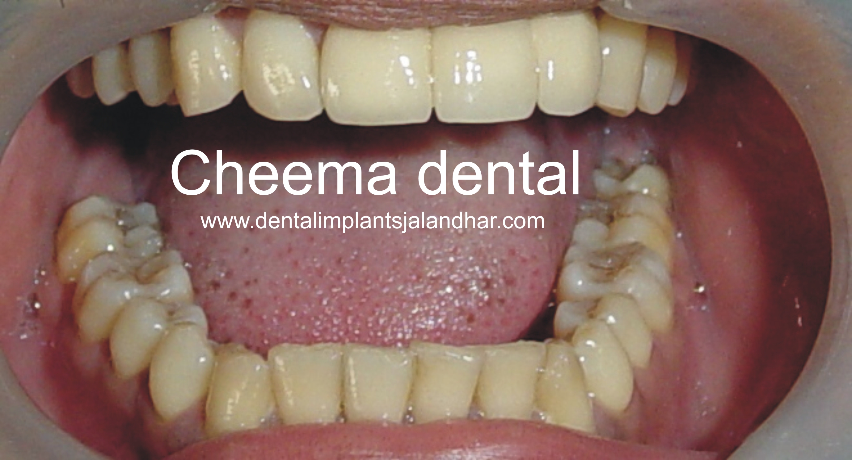 replaced with metal free computer fabricated bridge