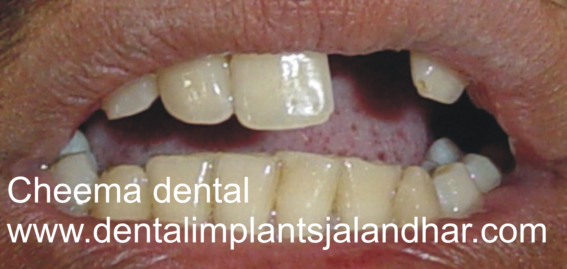 missing tooth from last 15 years